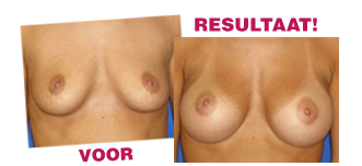 Afbeelding van de borsten van een vrouw met ervaring in het gebruik van Vacubreast