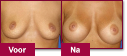 Resultaat van het gebruik van Vacubreast voor borstvergroting